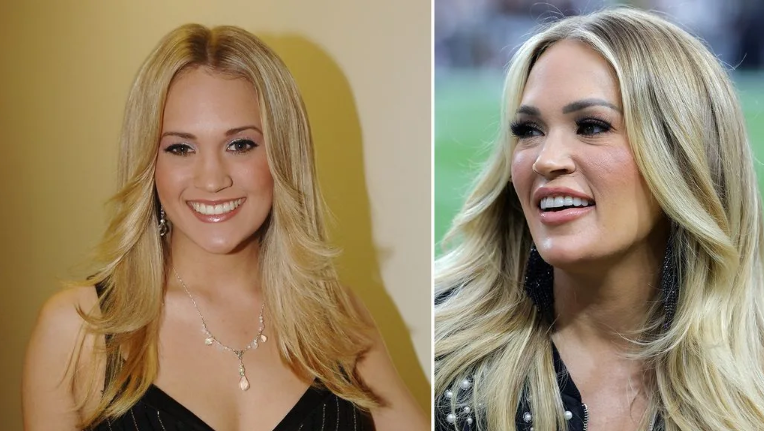 carrie underwood plastic surgery